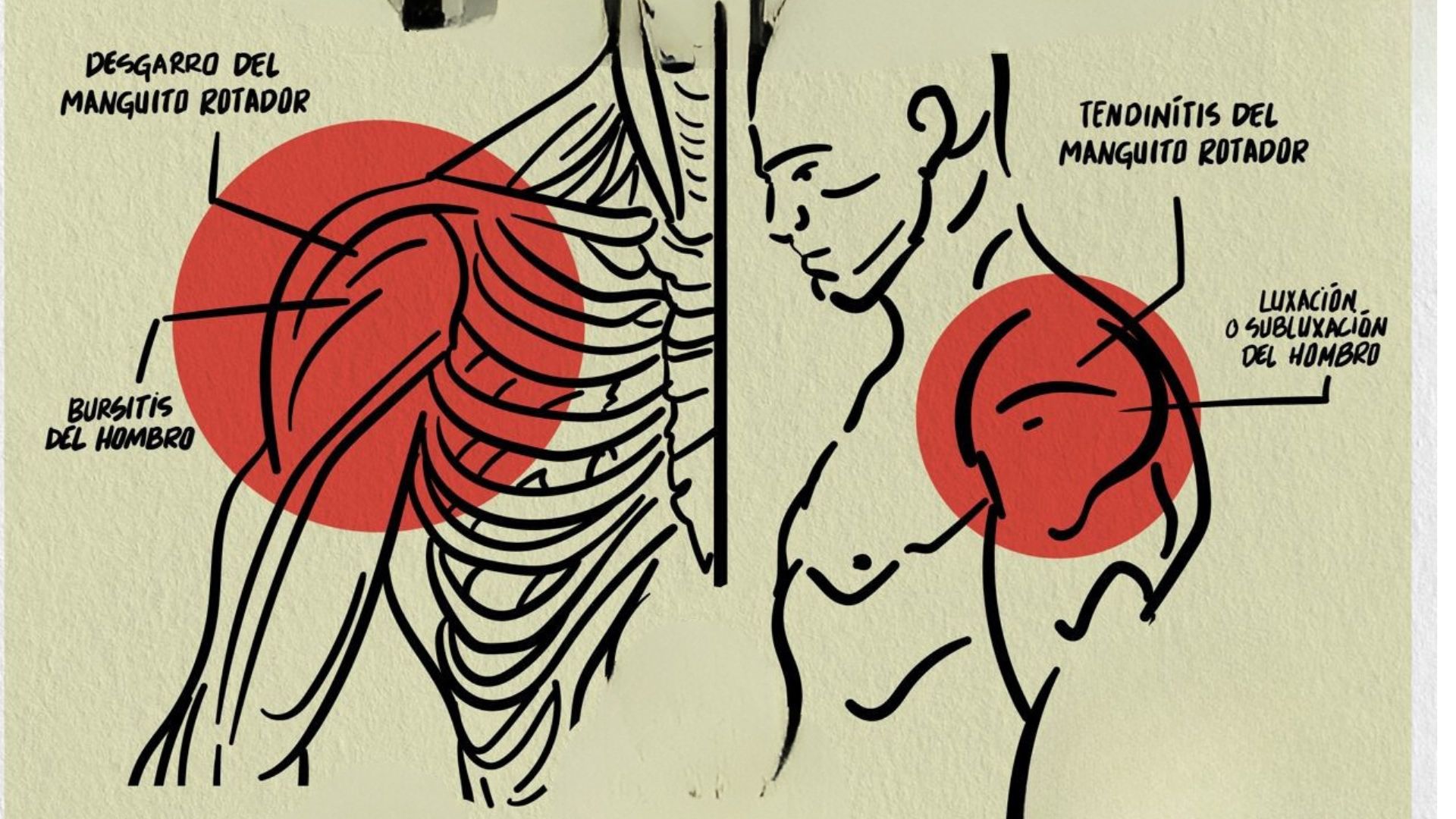 Ilustración anatómica de lesiones comunes en el hombro de escaladores: tendinitis, bursitis, luxación y desgarro del manguito rotador, señaladas con círculos rojos sobre un dibujo del torso humano.